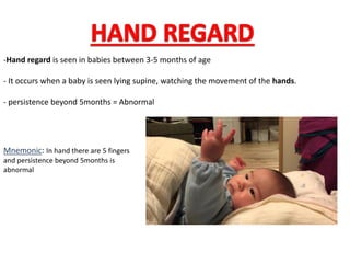 -Hand regard is seen in babies between 3-5 months of age
- It occurs when a baby is seen lying supine, watching the movement of the hands.
- persistence beyond 5months = Abnormal
Mnemonic: In hand there are 5 fingers
and persistence beyond 5months is
abnormal
 