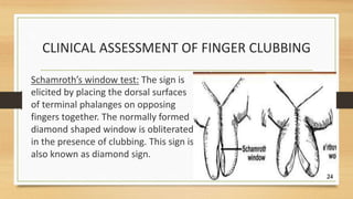 Finger Clubbing by Dr. Samuel2 Alawode.pptx