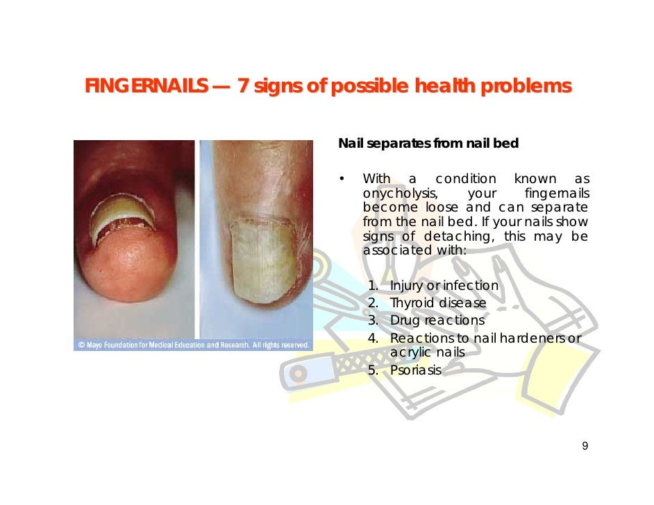 Fingernail Problems how to tell