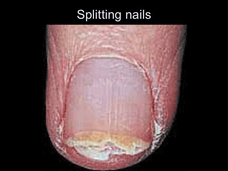 Cracked Nails Symptoms