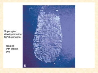 Super glue
developed under
UV illumination
Treated
with ardrox
dye
 