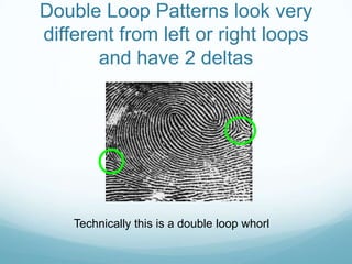 Double Loop Patterns look very
different from left or right loops
and have 2 deltas
Technically this is a double loop whorl
 