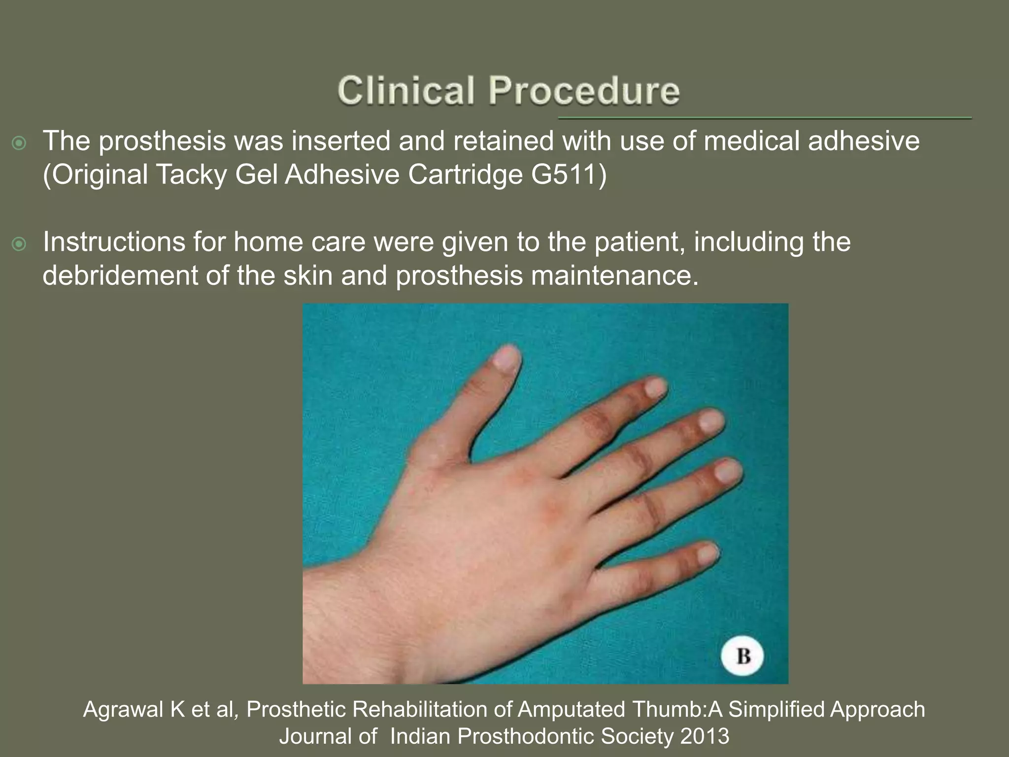  The prosthesis was inserted and retained with use of medical adhesive
(Original Tacky Gel Adhesive Cartridge G511)
 Instructions for home care were given to the patient, including the
debridement of the skin and prosthesis maintenance.
Agrawal K et al, Prosthetic Rehabilitation of Amputated Thumb:A Simplified Approach
Journal of Indian Prosthodontic Society 2013
 