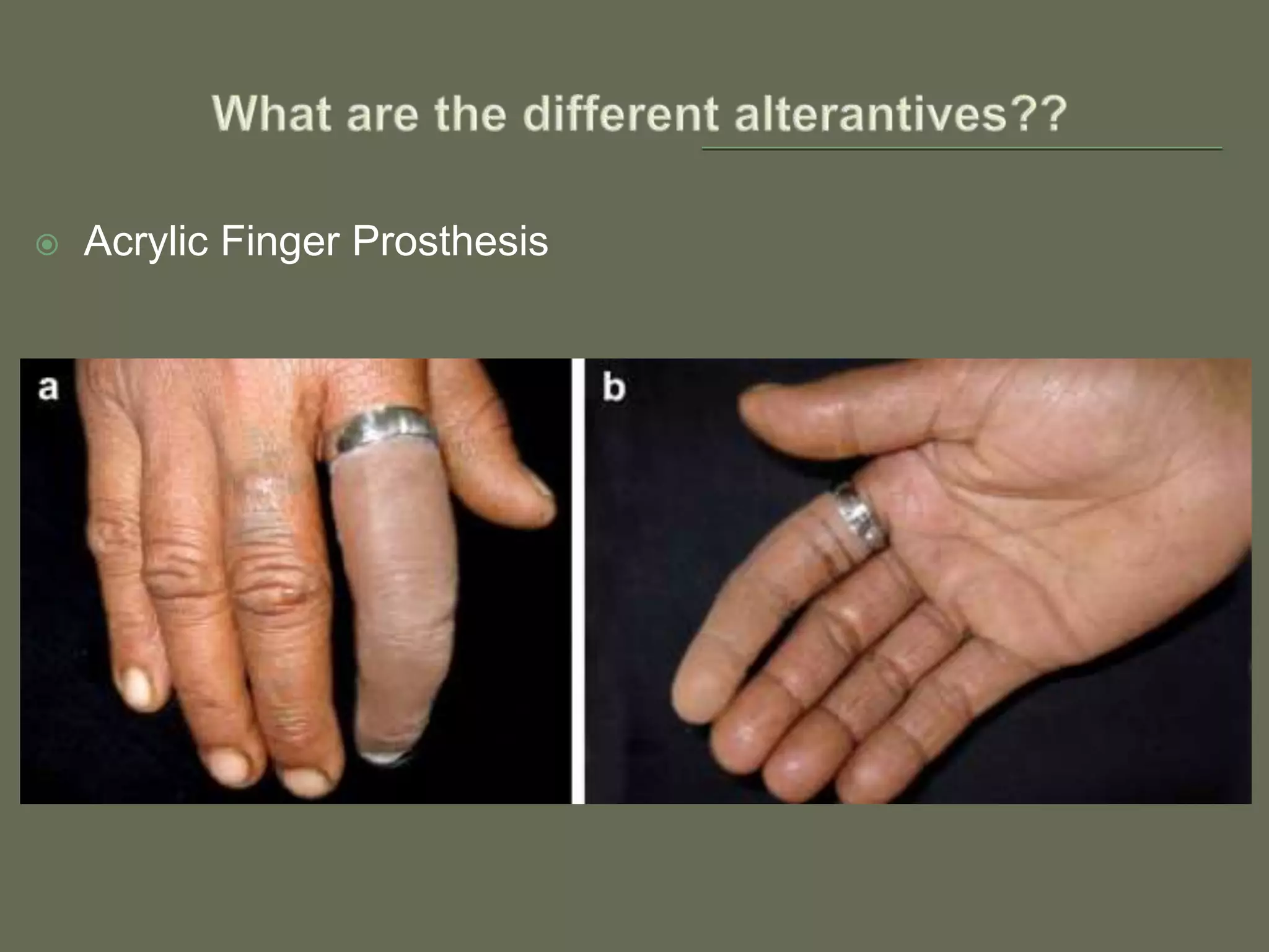  Acrylic Finger Prosthesis
 