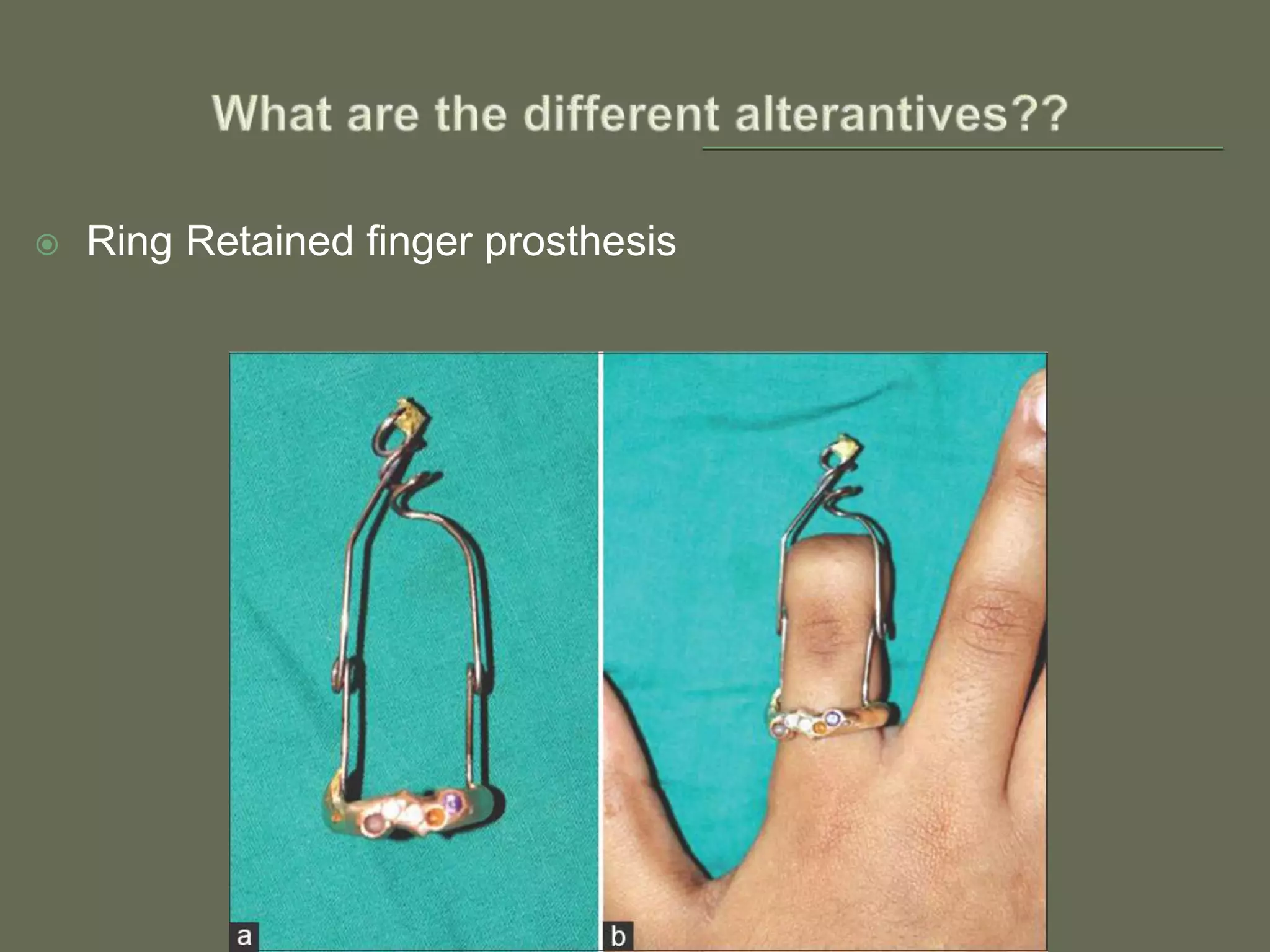  Ring Retained finger prosthesis
 
