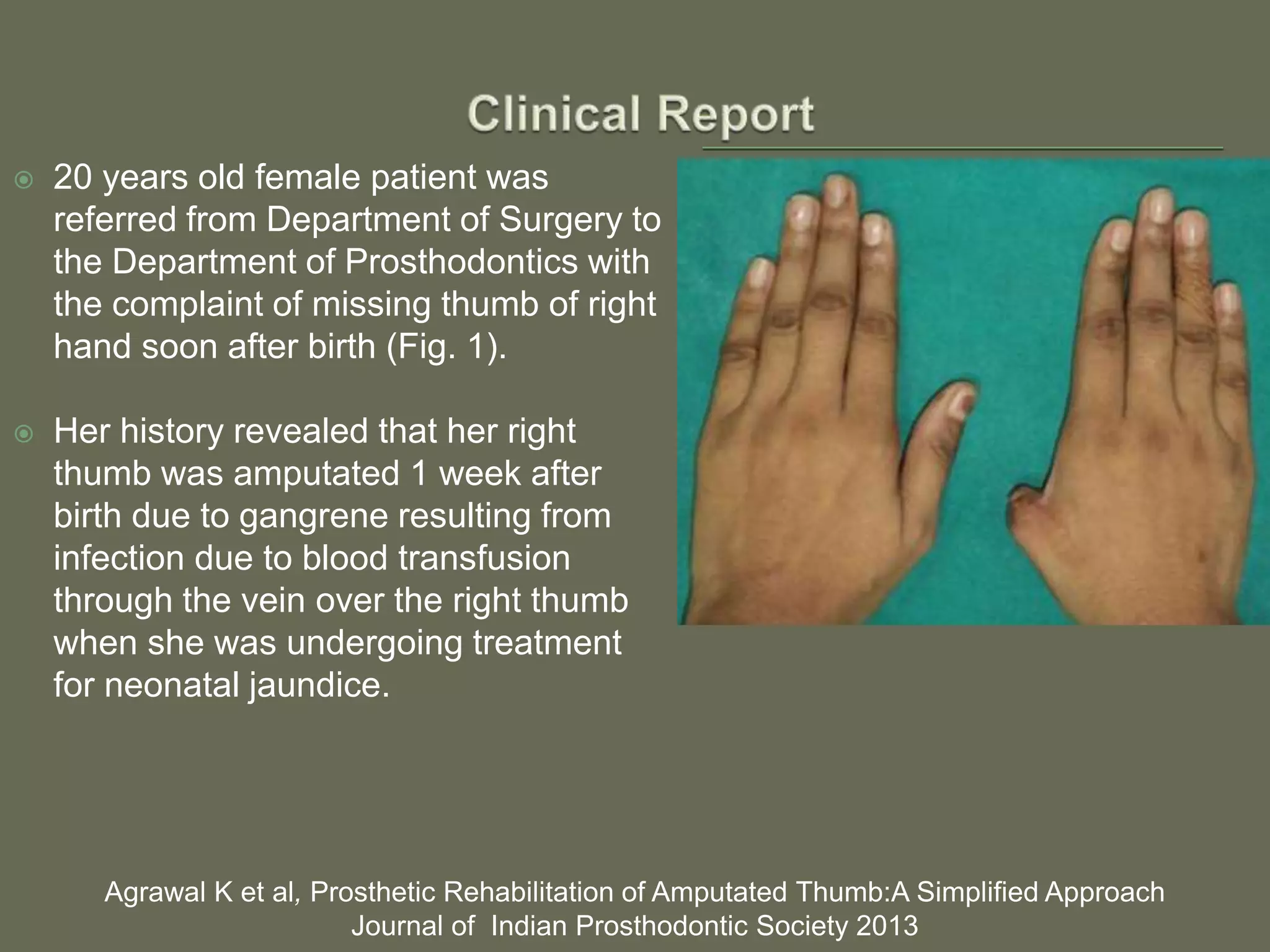  20 years old female patient was
referred from Department of Surgery to
the Department of Prosthodontics with
the complaint of missing thumb of right
hand soon after birth (Fig. 1).
 Her history revealed that her right
thumb was amputated 1 week after
birth due to gangrene resulting from
infection due to blood transfusion
through the vein over the right thumb
when she was undergoing treatment
for neonatal jaundice.
Agrawal K et al, Prosthetic Rehabilitation of Amputated Thumb:A Simplified Approach
Journal of Indian Prosthodontic Society 2013
 