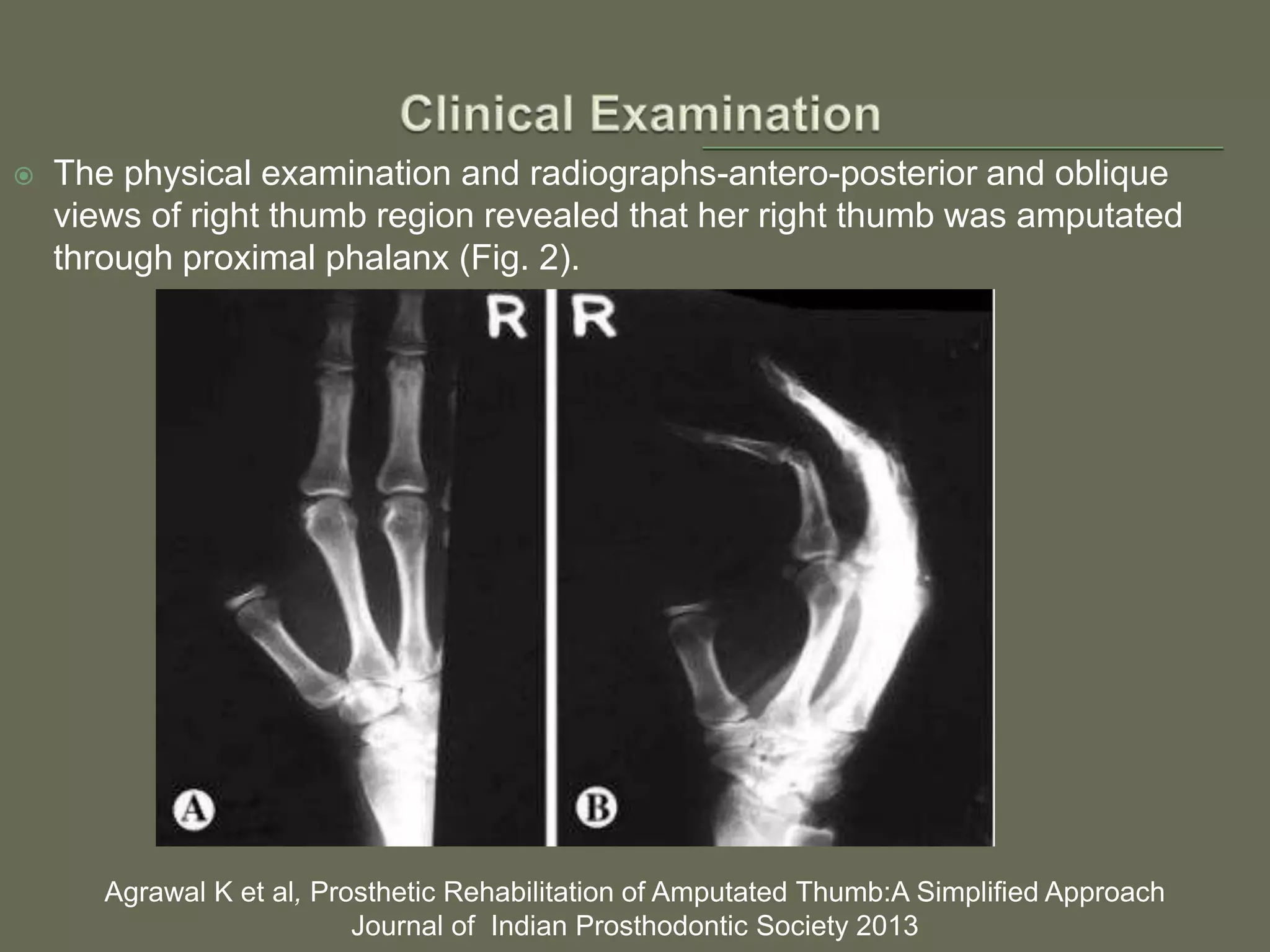  The physical examination and radiographs-antero-posterior and oblique
views of right thumb region revealed that her right thumb was amputated
through proximal phalanx (Fig. 2).
Agrawal K et al, Prosthetic Rehabilitation of Amputated Thumb:A Simplified Approach
Journal of Indian Prosthodontic Society 2013
 