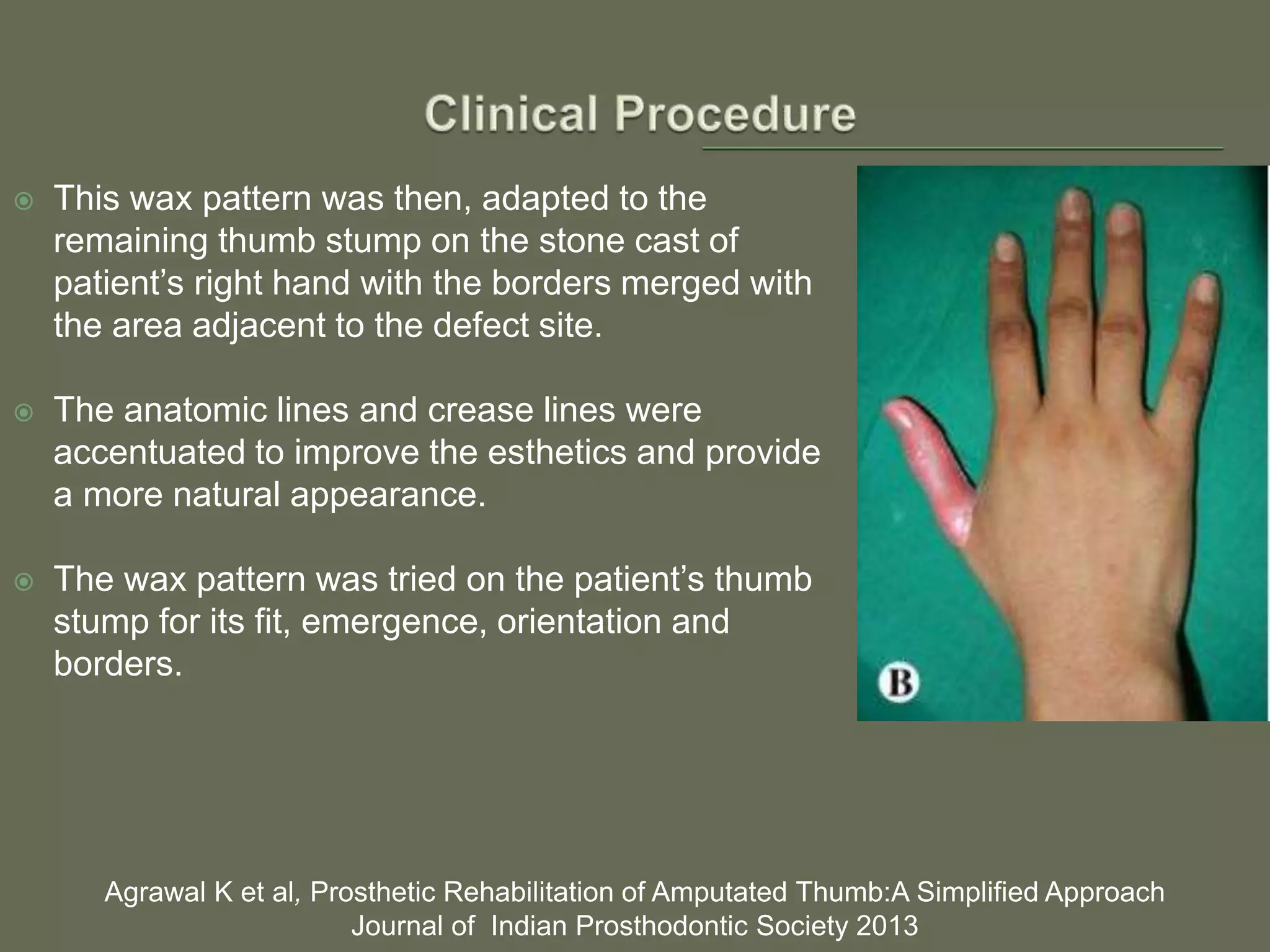  This wax pattern was then, adapted to the
remaining thumb stump on the stone cast of
patient’s right hand with the borders merged with
the area adjacent to the defect site.
 The anatomic lines and crease lines were
accentuated to improve the esthetics and provide
a more natural appearance.
 The wax pattern was tried on the patient’s thumb
stump for its fit, emergence, orientation and
borders.
Agrawal K et al, Prosthetic Rehabilitation of Amputated Thumb:A Simplified Approach
Journal of Indian Prosthodontic Society 2013
 