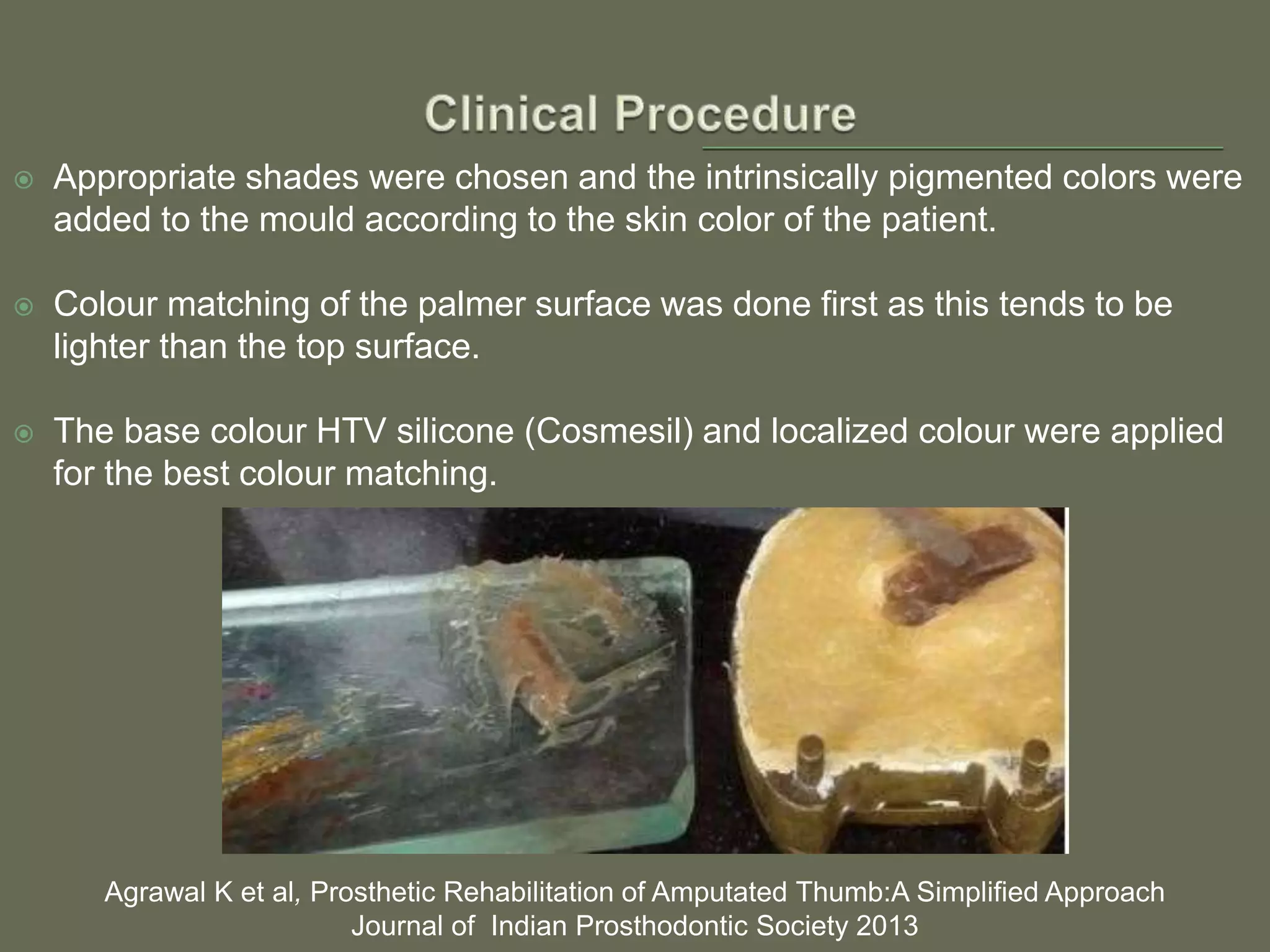  Appropriate shades were chosen and the intrinsically pigmented colors were
added to the mould according to the skin color of the patient.
 Colour matching of the palmer surface was done first as this tends to be
lighter than the top surface.
 The base colour HTV silicone (Cosmesil) and localized colour were applied
for the best colour matching.
Agrawal K et al, Prosthetic Rehabilitation of Amputated Thumb:A Simplified Approach
Journal of Indian Prosthodontic Society 2013
 