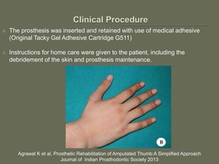  The prosthesis was inserted and retained with use of medical adhesive
(Original Tacky Gel Adhesive Cartridge G511)
 Instructions for home care were given to the patient, including the
debridement of the skin and prosthesis maintenance.
Agrawal K et al, Prosthetic Rehabilitation of Amputated Thumb:A Simplified Approach
Journal of Indian Prosthodontic Society 2013
 