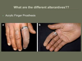  Acrylic Finger Prosthesis
 