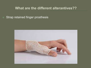  Strap retained finger prosthesis
 