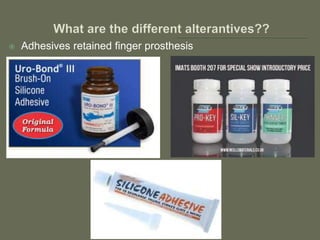  Adhesives retained finger prosthesis
 