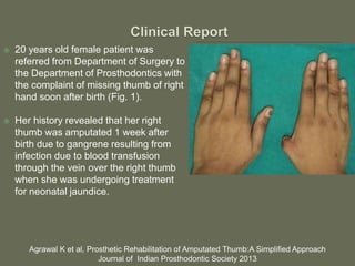  20 years old female patient was
referred from Department of Surgery to
the Department of Prosthodontics with
the complaint of missing thumb of right
hand soon after birth (Fig. 1).
 Her history revealed that her right
thumb was amputated 1 week after
birth due to gangrene resulting from
infection due to blood transfusion
through the vein over the right thumb
when she was undergoing treatment
for neonatal jaundice.
Agrawal K et al, Prosthetic Rehabilitation of Amputated Thumb:A Simplified Approach
Journal of Indian Prosthodontic Society 2013
 