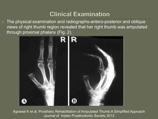  The physical examination and radiographs-antero-posterior and oblique
views of right thumb region revealed that her right thumb was amputated
through proximal phalanx (Fig. 2).
Agrawal K et al, Prosthetic Rehabilitation of Amputated Thumb:A Simplified Approach
Journal of Indian Prosthodontic Society 2013
 