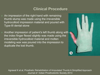  An impression of the right hand with remaining
thumb stump was made using the irreversible
hydrocolloid impression material and poured with
Type-III dental stone
 Another impression of patient’s left thumb along with
the index finger flexed slightly was made using the
irreversible hydrocolloid material and molten
modeling wax was poured into the impression to
duplicate the lost thumb.
Agrawal K et al, Prosthetic Rehabilitation of Amputated Thumb:A Simplified Approach
Journal of Indian Prosthodontic Society 2013
 