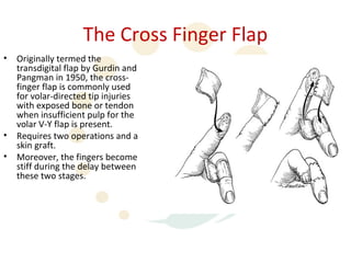 Finger Rip Pulp Fingertip recon | PPT