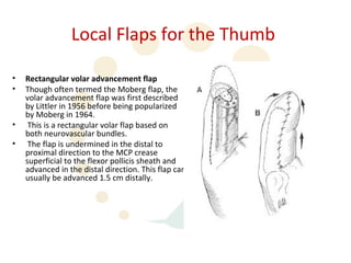 Local Flaps for the Thumb

•   Rectangular volar advancement flap
•   Though often termed the Moberg flap, the
    volar advancement flap was first described
    by Littler in 1956 before being popularized
    by Moberg in 1964.
•    This is a rectangular volar flap based on
    both neurovascular bundles.
•    The flap is undermined in the distal to
    proximal direction to the MCP crease
    superficial to the flexor pollicis sheath and
    advanced in the distal direction. This flap can
    usually be advanced 1.5 cm distally.
 