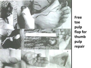 Finger Rip Pulp Finger tip injuries & management | PPTX