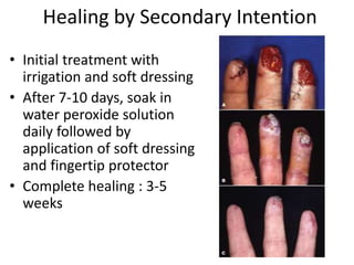 Healing by Secondary Intention
• Initial treatment with
irrigation and soft dressing
• After 7-10 days, soak in
water peroxide solution
daily followed by
application of soft dressing
and fingertip protector
• Complete healing : 3-5
weeks
 