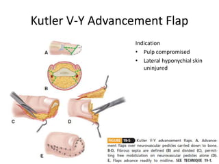 Kutler V-Y Advancement Flap
Indication
• Pulp compromised
• Lateral hyponychial skin
uninjured
 