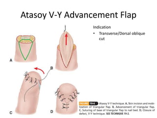 Atasoy V-Y Advancement Flap
Indication
• Transverse/Dorsal oblique
cut
 