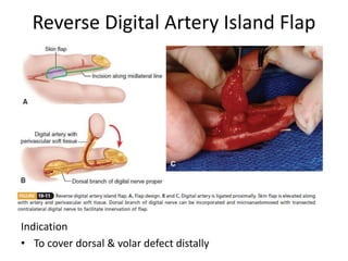 Reverse Digital Artery Island Flap
Indication
• To cover dorsal & volar defect distally
 