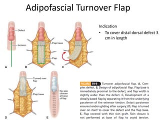 Adipofascial Turnover Flap
Indication
• To cover distal dorsal defect 3
cm in length
 