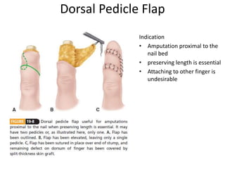 Dorsal Pedicle Flap
Indication
• Amputation proximal to the
nail bed
• preserving length is essential
• Attaching to other finger is
undesirable
 