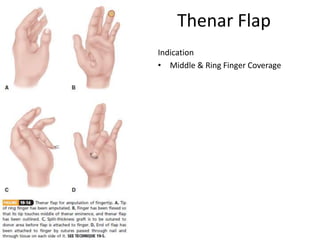 Thenar Flap
Indication
• Middle & Ring Finger Coverage
 