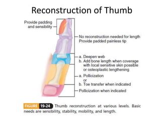 Reconstruction of Thumb
 