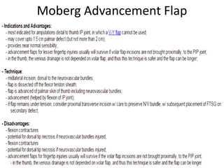 Moberg Advancement Flap
 