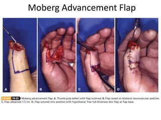 Moberg Advancement Flap
 
