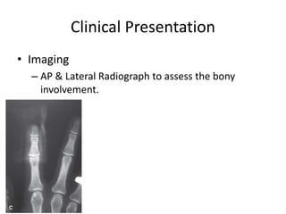 Clinical Presentation
• Imaging
– AP & Lateral Radiograph to assess the bony
involvement.
 