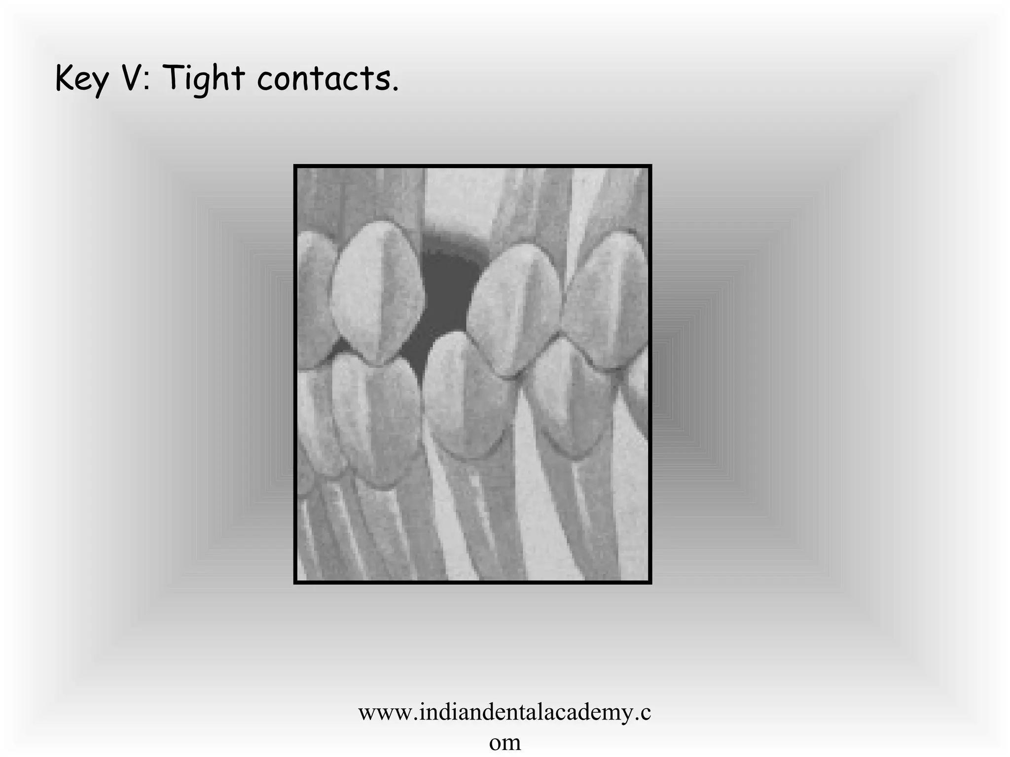 Key V: Tight contacts.
www.indiandentalacademy.c
om
 