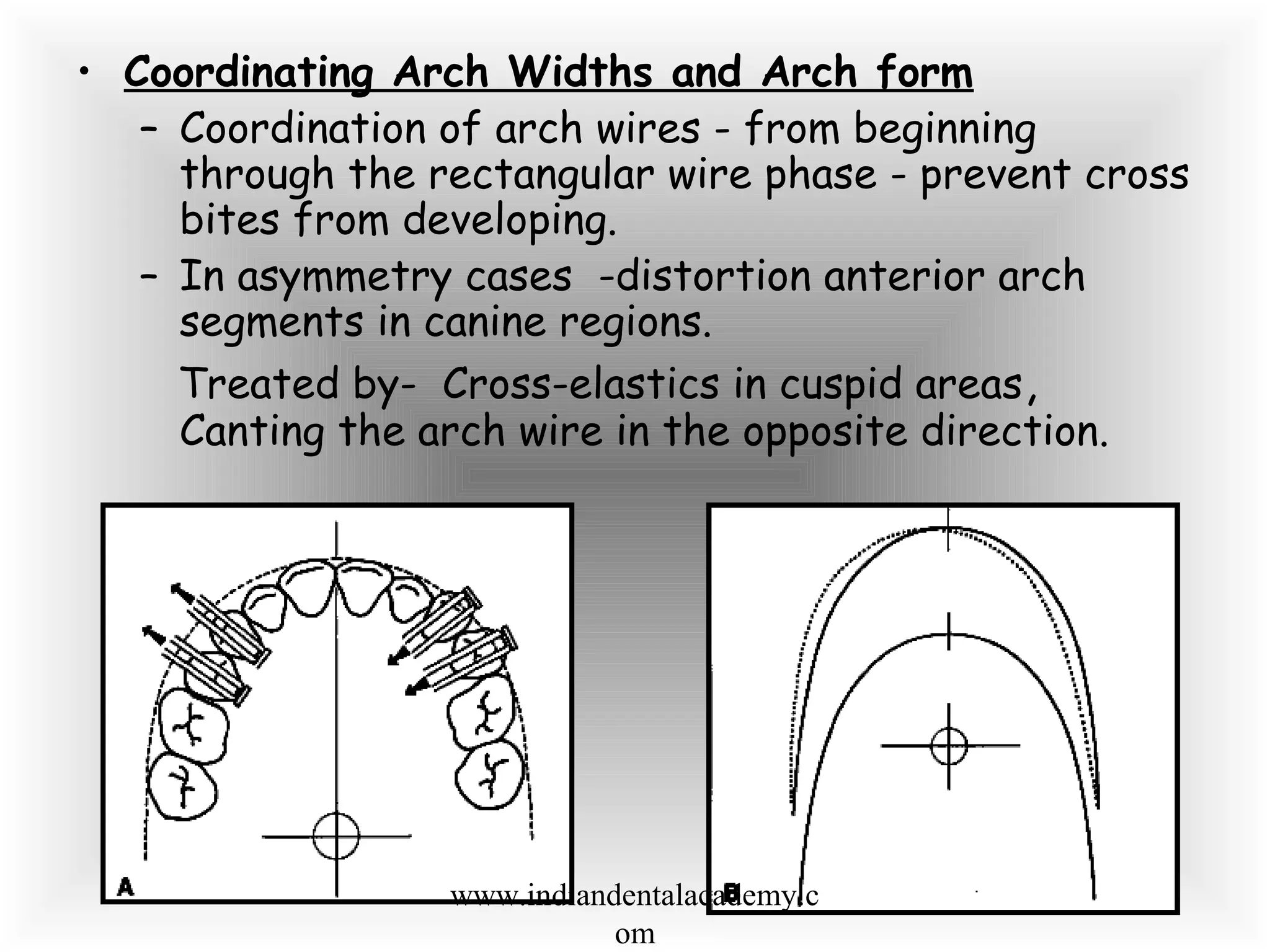 • Coordinating Arch Widths and Arch form
– Coordination of arch wires - from beginning
through the rectangular wire phase - prevent cross
bites from developing.
– In asymmetry cases -distortion anterior arch
segments in canine regions.
Treated by- Cross-elastics in cuspid areas,
Canting the arch wire in the opposite direction.
www.indiandentalacademy.c
om
 