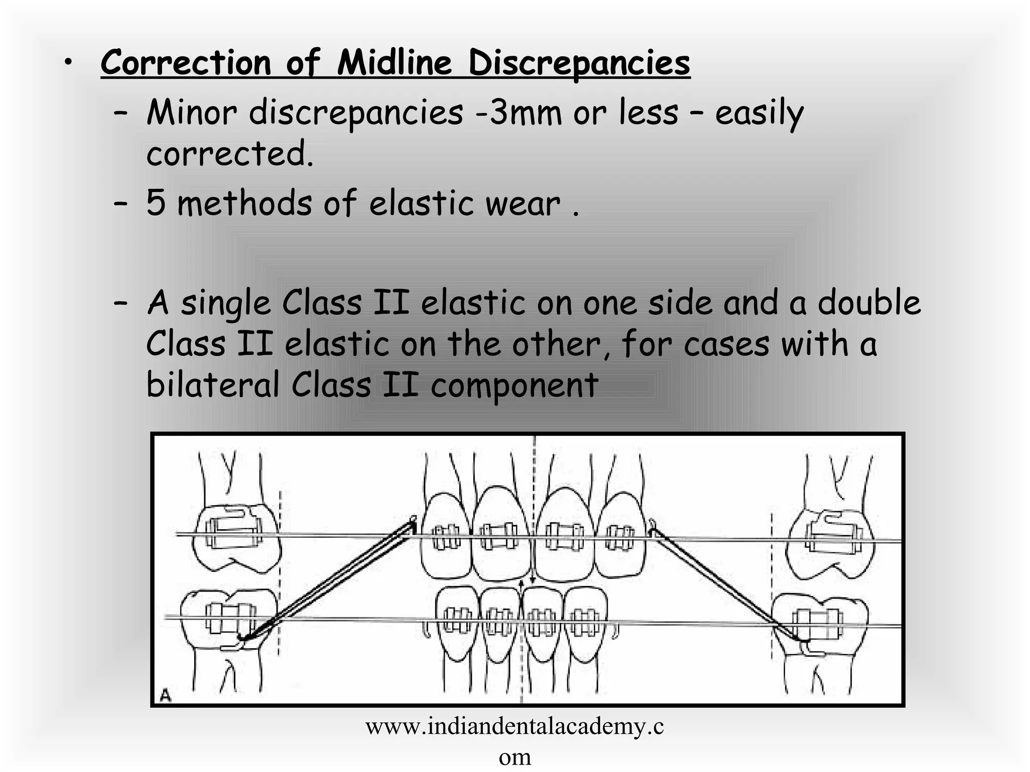 • Correction of Midline Discrepancies
– Minor discrepancies -3mm or less – easily
corrected.
– 5 methods of elastic wear .
– A single Class II elastic on one side and a double
Class II elastic on the other, for cases with a
bilateral Class II component
www.indiandentalacademy.c
om
 