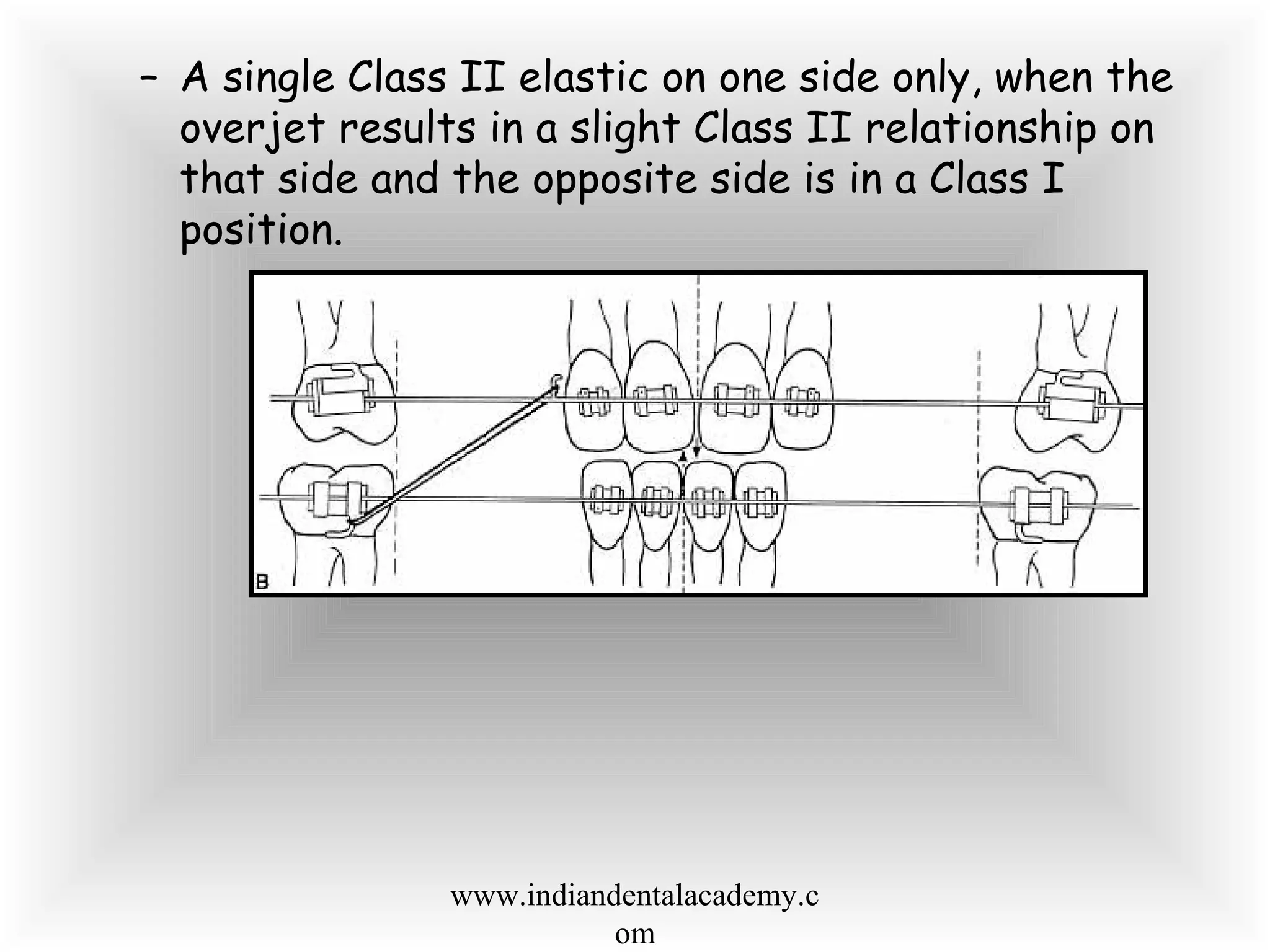 – A single Class II elastic on one side only, when the
overjet results in a slight Class II relationship on
that side and the opposite side is in a Class I
position.
www.indiandentalacademy.c
om
 