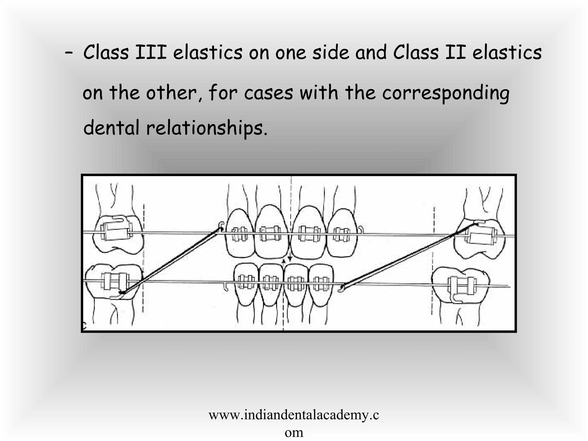 – Class III elastics on one side and Class II elastics
on the other, for cases with the corresponding
dental relationships.
www.indiandentalacademy.c
om
 