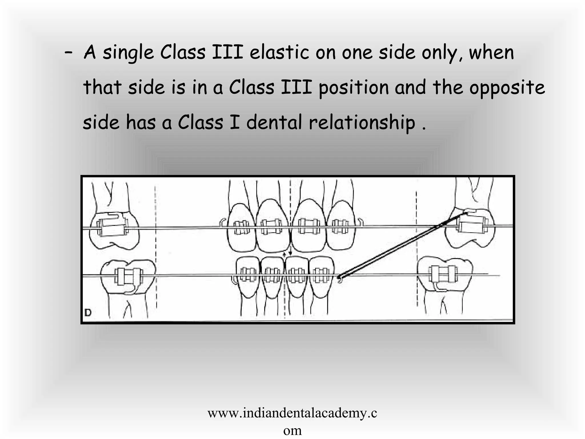 – A single Class III elastic on one side only, when
that side is in a Class III position and the opposite
side has a Class I dental relationship .
www.indiandentalacademy.c
om
 