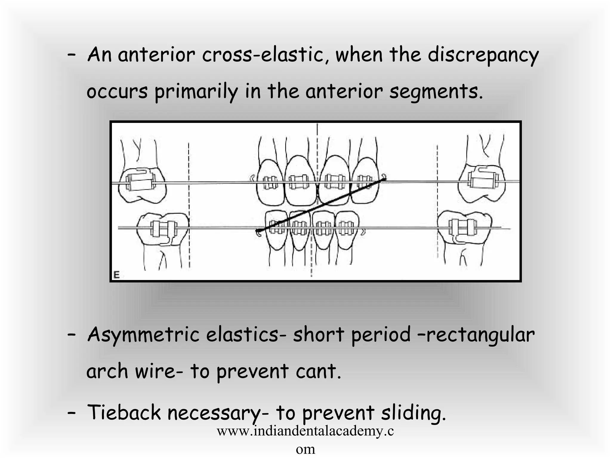 – An anterior cross-elastic, when the discrepancy
occurs primarily in the anterior segments.
– Asymmetric elastics- short period –rectangular
arch wire- to prevent cant.
– Tieback necessary- to prevent sliding.
www.indiandentalacademy.c
om
 
