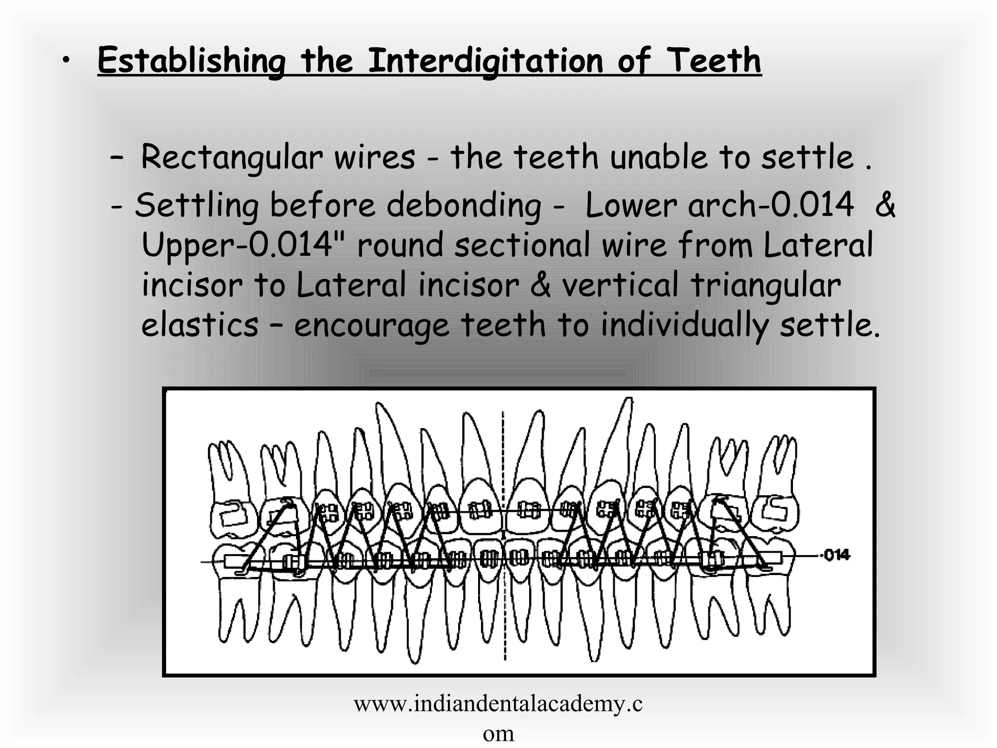 • Establishing the Interdigitation of Teeth
– Rectangular wires - the teeth unable to settle .
- Settling before debonding - Lower arch-0.014 &
Upper-0.014" round sectional wire from Lateral
incisor to Lateral incisor & vertical triangular
elastics – encourage teeth to individually settle.
www.indiandentalacademy.c
om
 