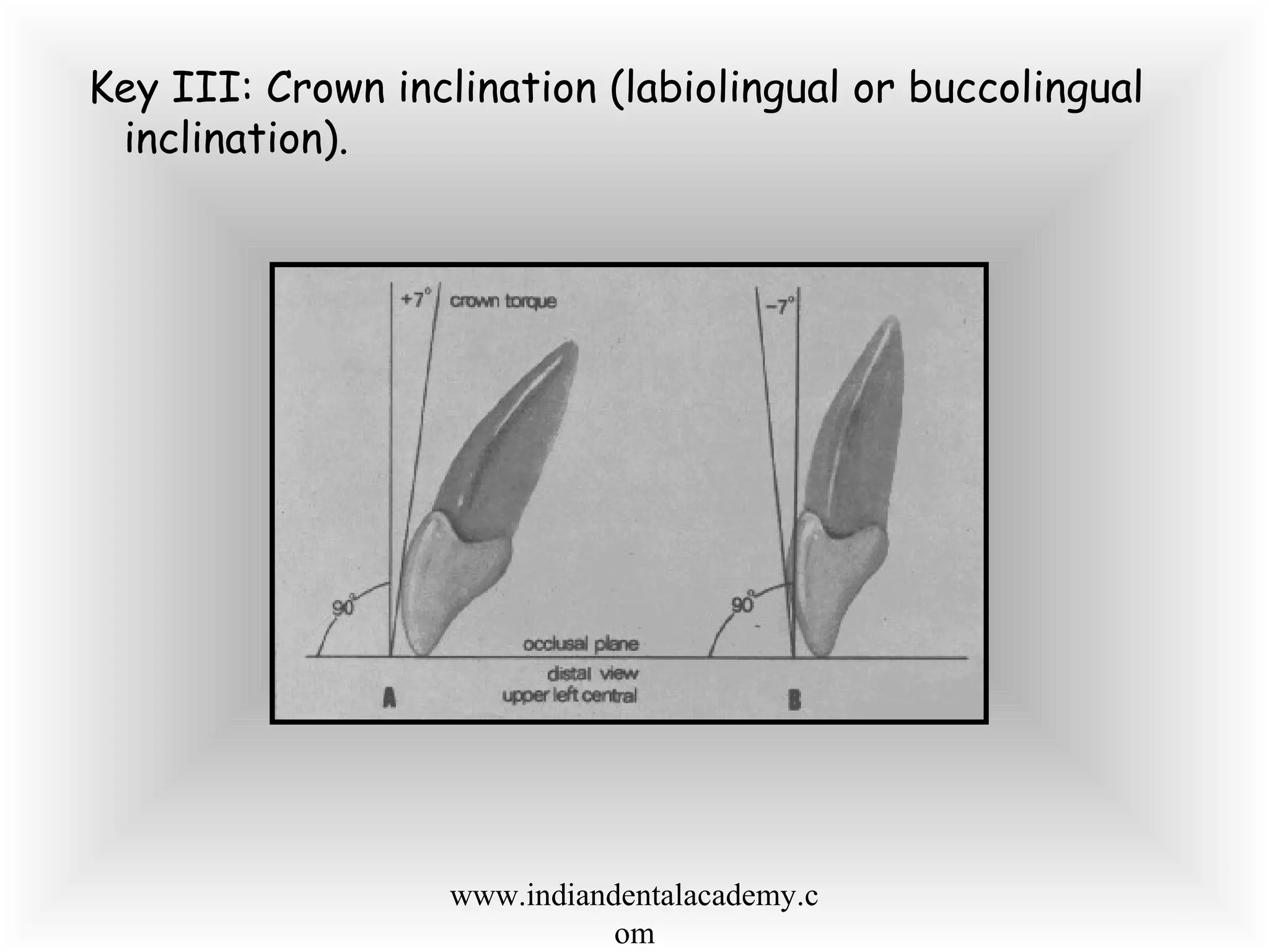 Key III: Crown inclination (labiolingual or buccolingual
inclination).
www.indiandentalacademy.c
om
 