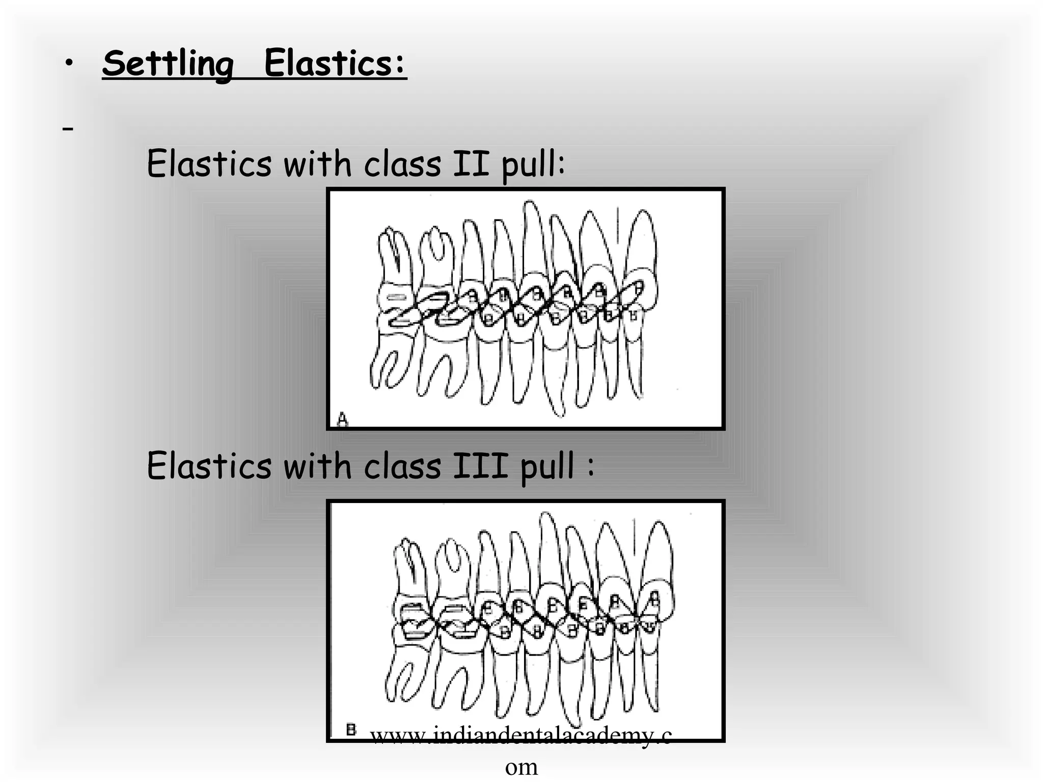 • Settling Elastics:
Elastics with class II pull:
Elastics with class III pull :
www.indiandentalacademy.c
om
 