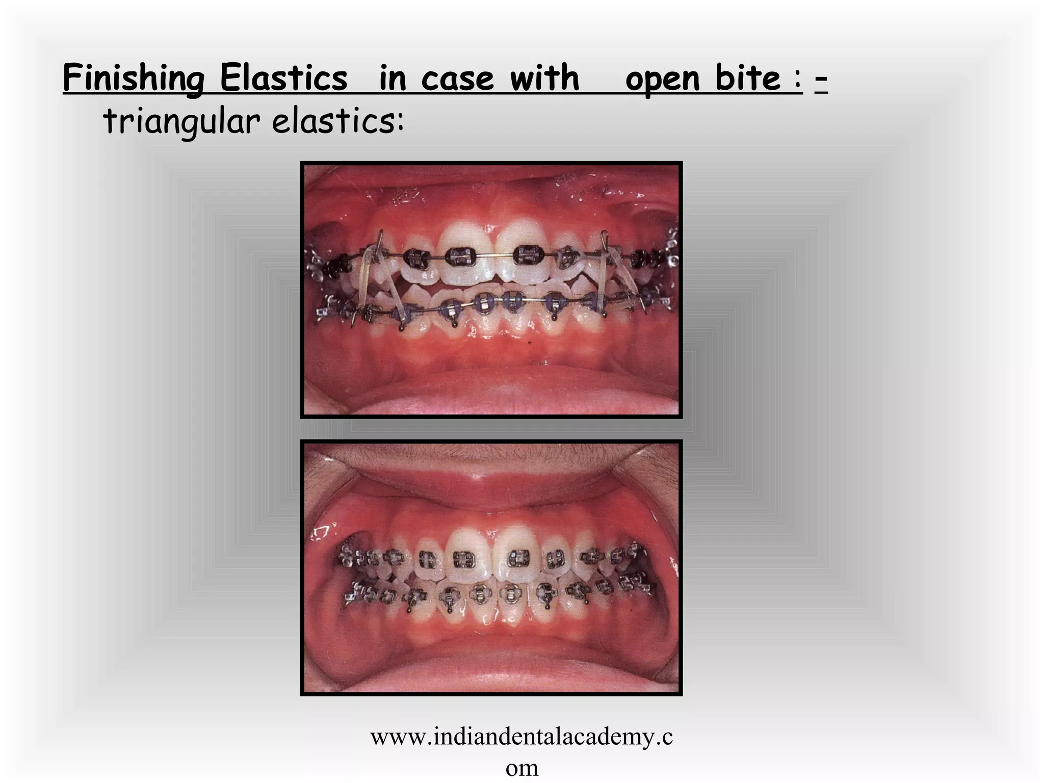 Finishing Elastics in case with open bite : -
triangular elastics:
www.indiandentalacademy.c
om
 
