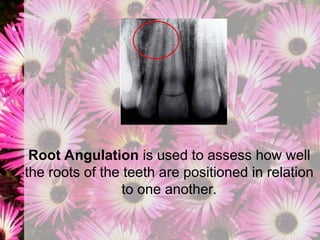 finishing and detailing in orthodontics.ppt