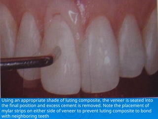 Finishing and Polishing of Restorations. | PPT
