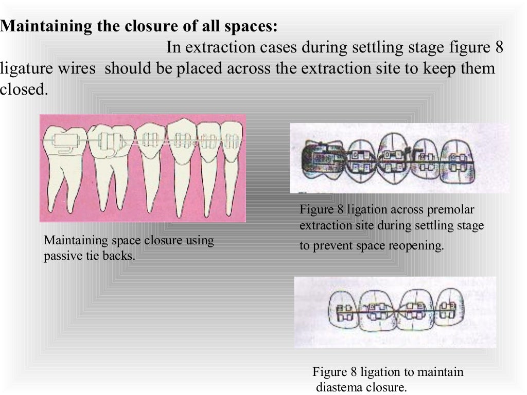 Finishing & detailing in contemporary orthodontics / fixed orthodont…