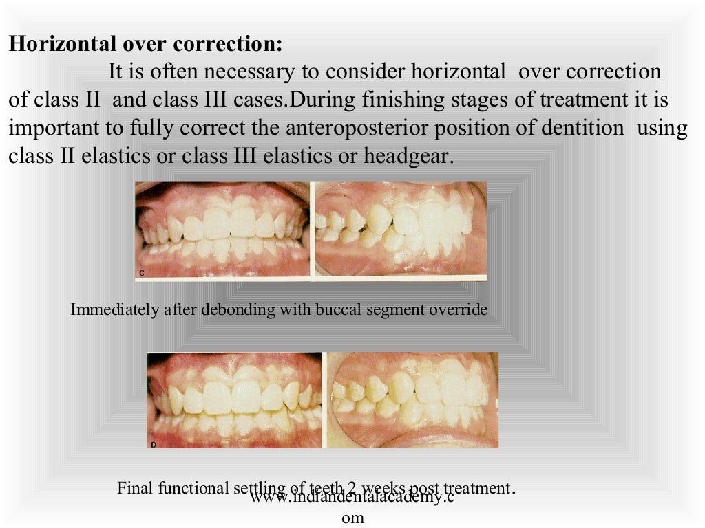 Finishing & detailing in orthodontics / fixed orthodontics course