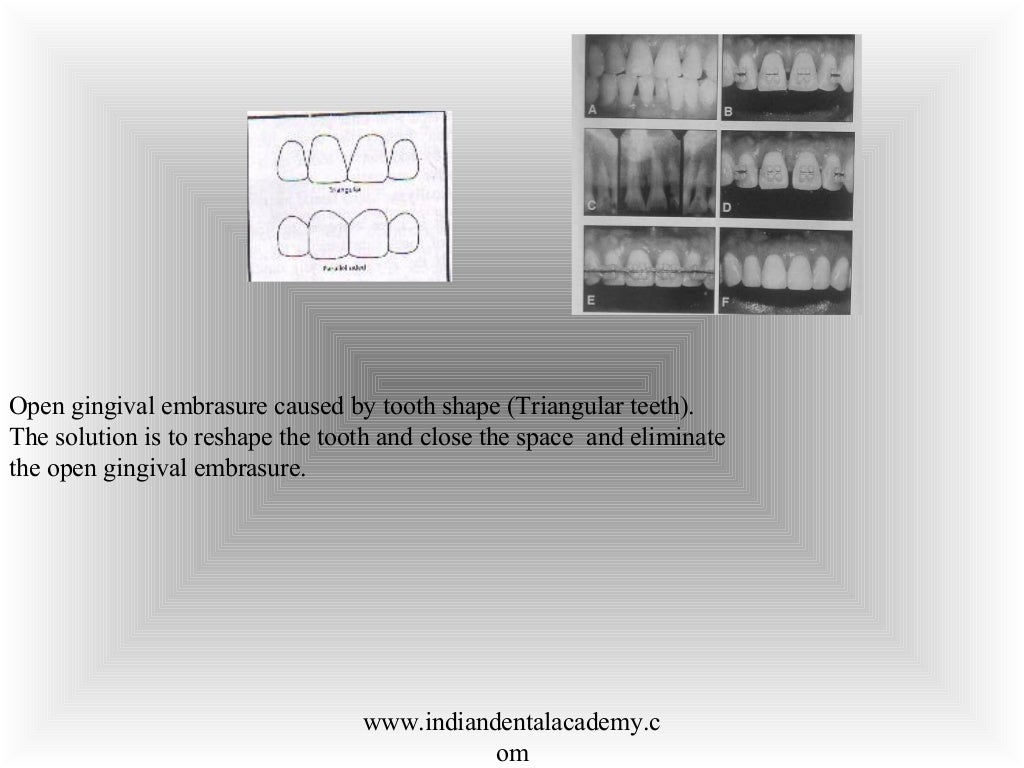 Finishing & detailing in orthodontics / fixed orthodontics course